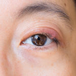 Blepharitis | ozidex