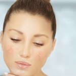 Rosacea | ozidex