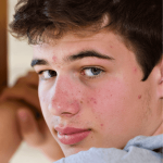 Acne Treatment | ozidex