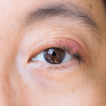 Blepharitis