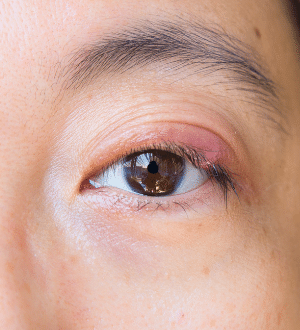 Blepharitis