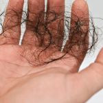 Hair loss