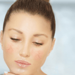 Exacerbation of rosacea | ozidex
