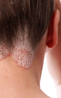 Severe eczema caused by Demodex ticks