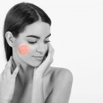 Rosacea
