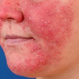 The Cause of Rosacea