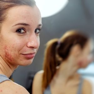 Fungal Acne: Signs, Causes, Diagnosis, Treatment | Demodex