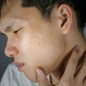 Treatment of Fungal Acne Demodex and Fungal Acne