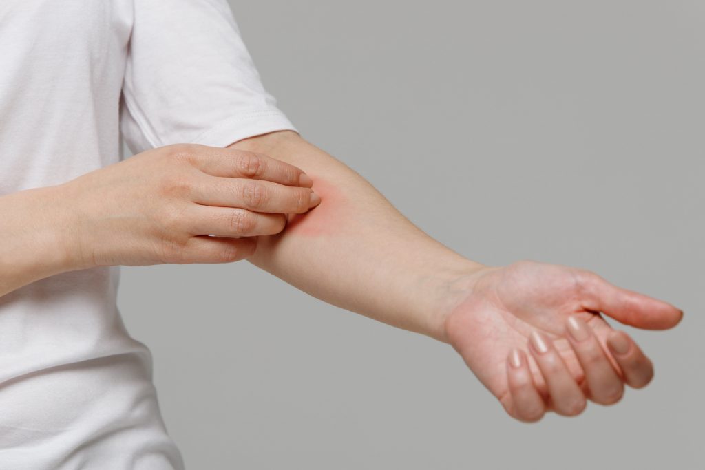 Topical treatments for itching