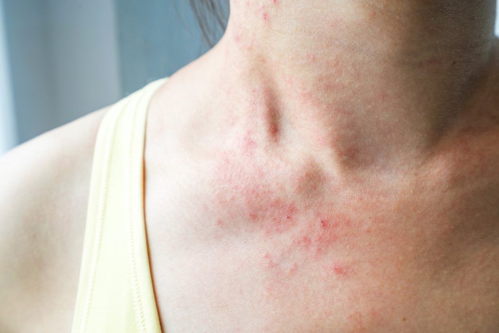 (UVB) for reducing itching