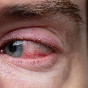 Posterior Blepharitis (demodex)