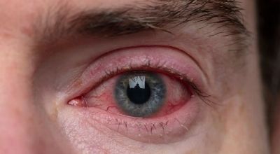demodex mites causes blepharitis