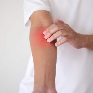 eczema symptoms