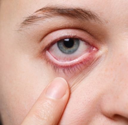 Eyelash mites