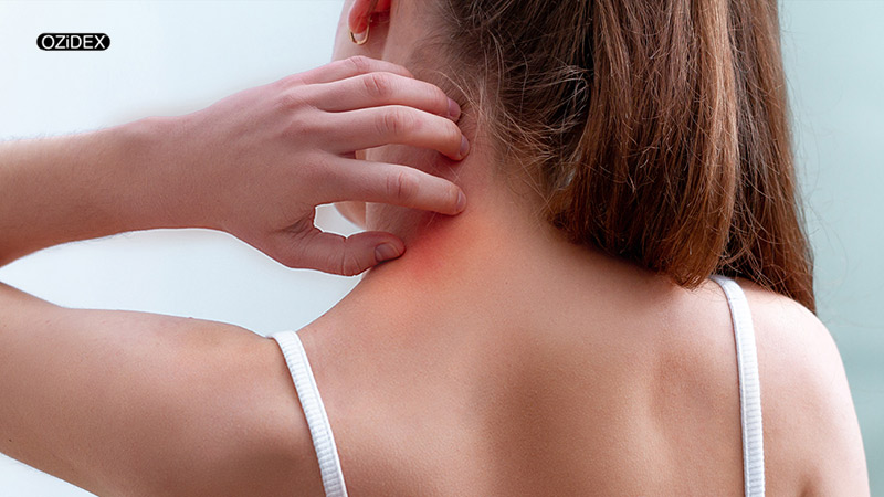 Feeling of itching and crawling sensation on scalp-ozidex