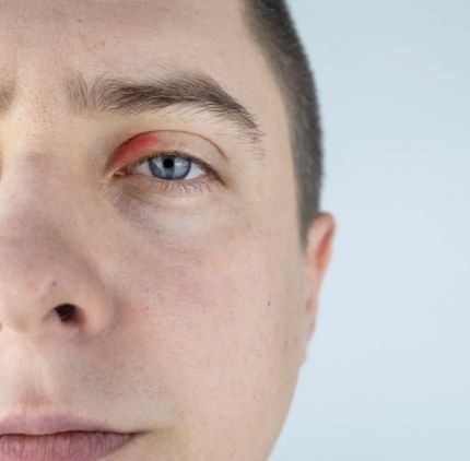 blepharitis and demodex