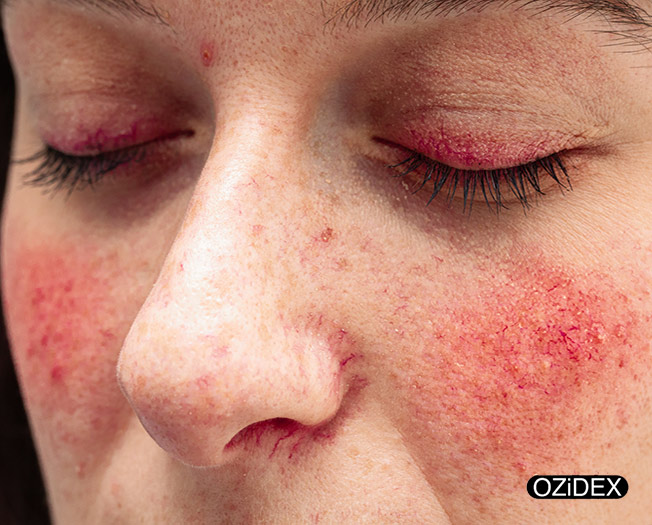 Signs demodex mites are dying-ozidex