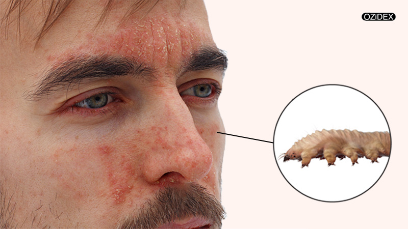 Demodex Die Off Symptoms - OZIDEX Demodex Die Off Symptoms - OZIDEX