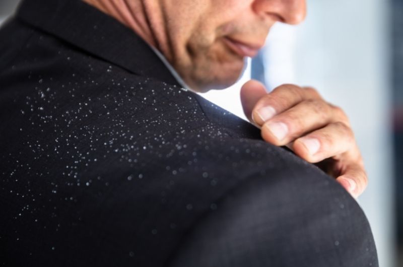 Dandruff and hair loss does dandruff cause hair loss