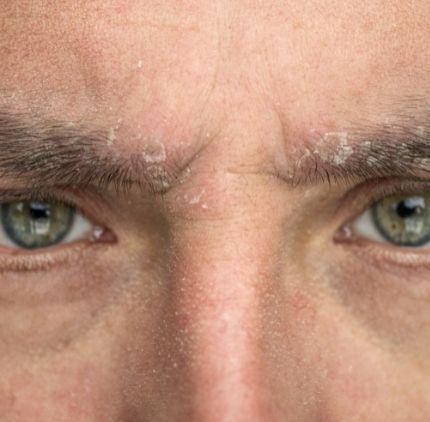 contact dermatitis | ozidex