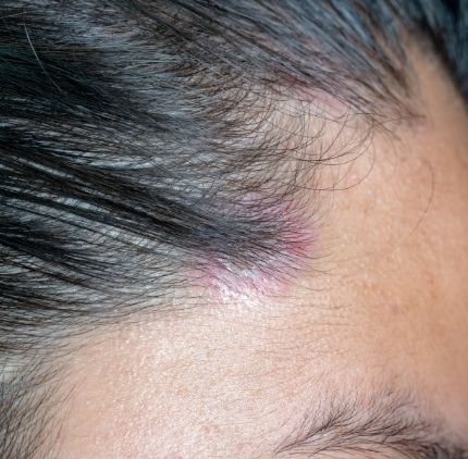 scalp psoriasis
