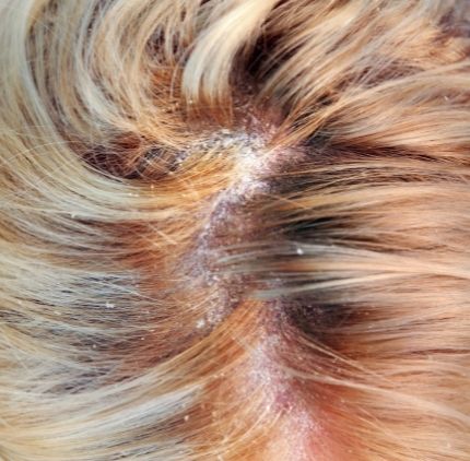 seborrheic dermatitis
