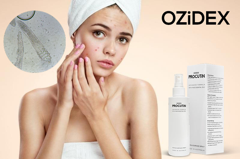 difference between acne and pimple