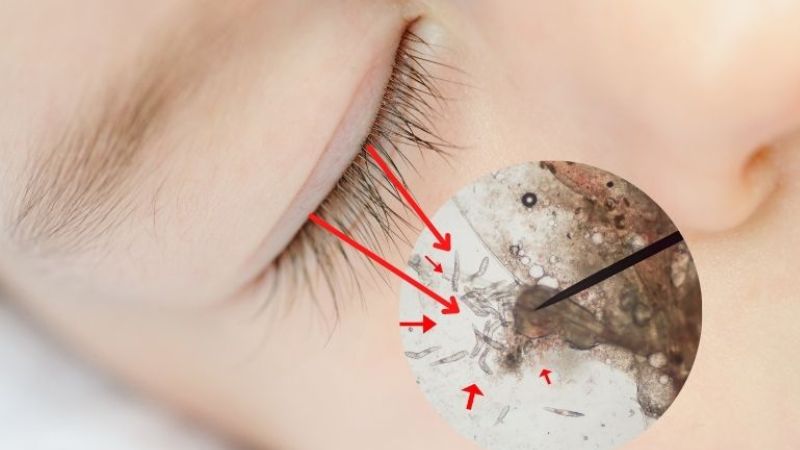 Eyelash extension mites and how prevent them | ozidex