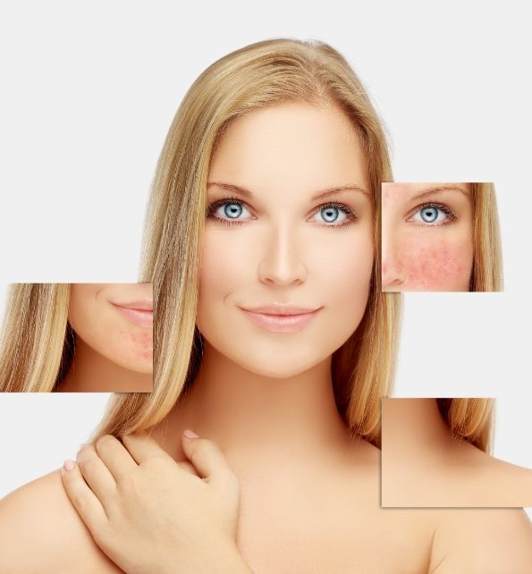 rosacea
