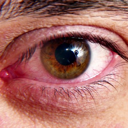 Causes of ocular rosacea-Ozidex
