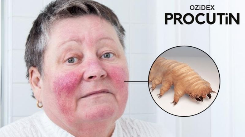 What is red skin syndrome (RSS)-Ozidex