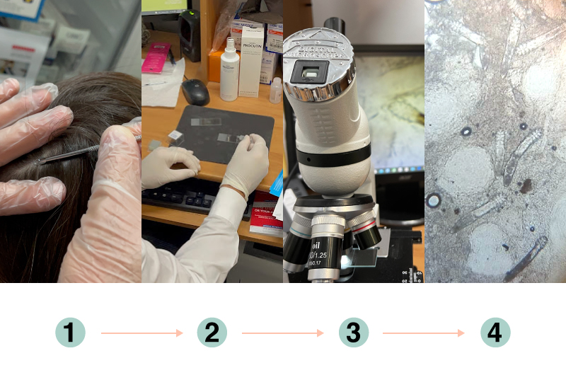demodex test