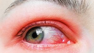 ocular rosacea
