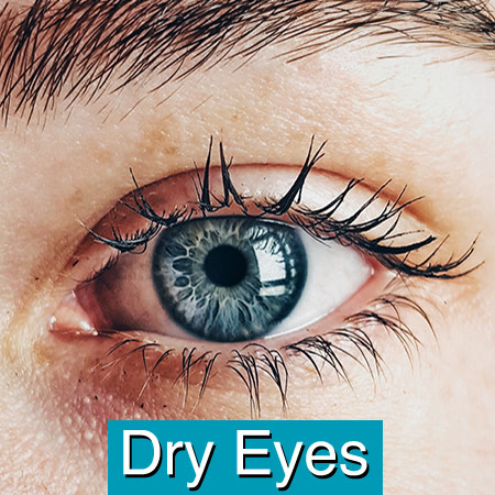 Symptoms of Ocular Rosacea