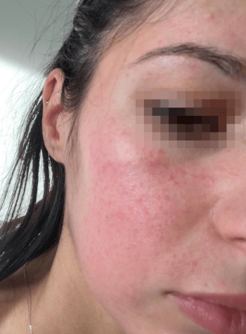 before-rosacea-demodex
