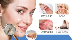 demodex and skin issues | Ungex