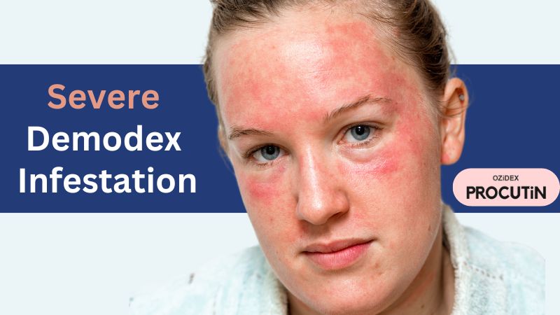 Severe Demodex Infestation: Understanding the Issue and Finding Relief